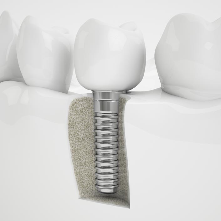 Dental Implants - Dental Services